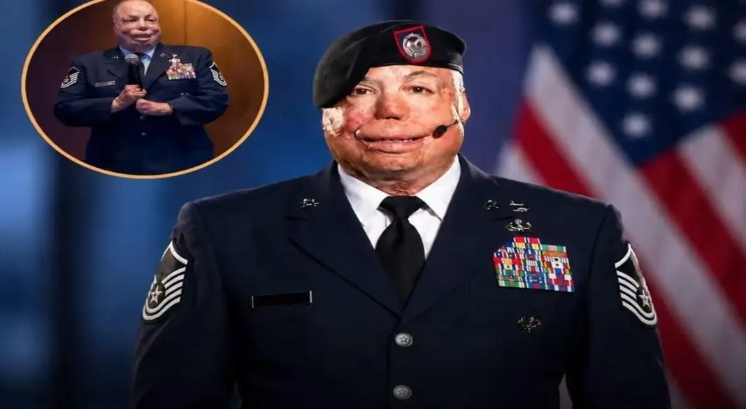 U.S. Airman Defies 15% Survival Odds After Suffering Burns to 80% of His Body